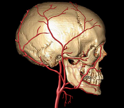 Sténose carotidienne : examen de l'artère carotide par doppler