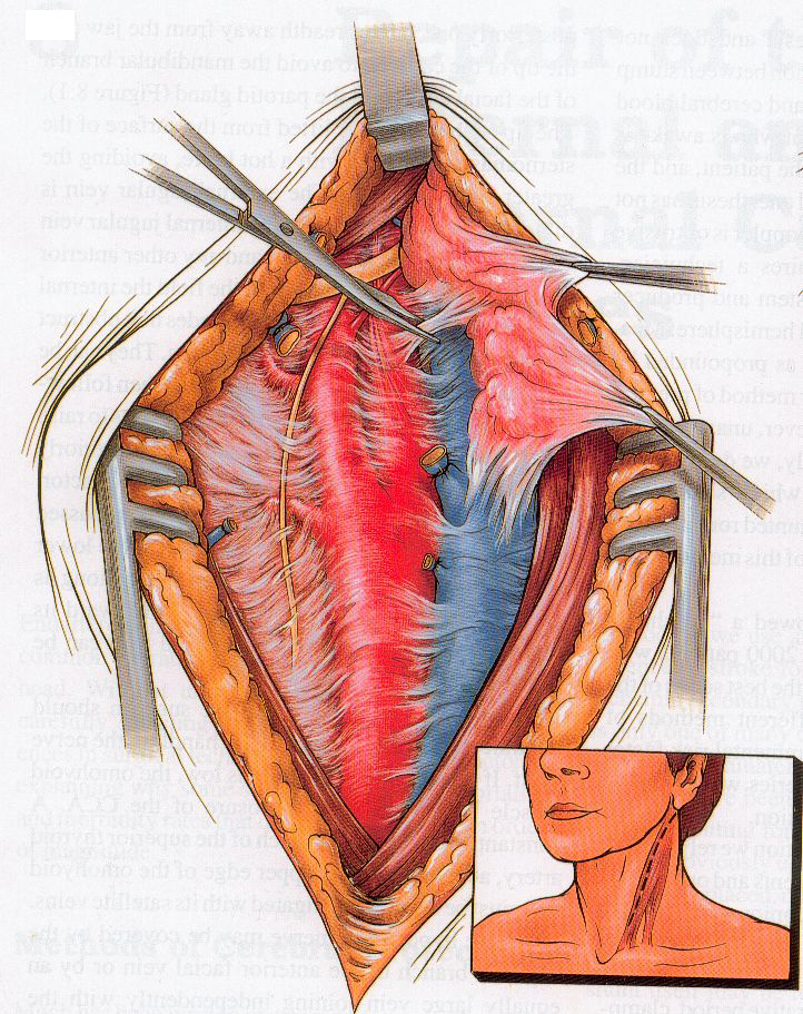 Sténose carotidienne : examen de l'artère carotide par doppler