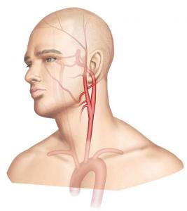 carotide-figure1_large